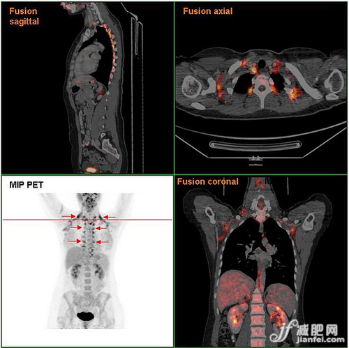 新知：“棕色脂肪”讓你瘦