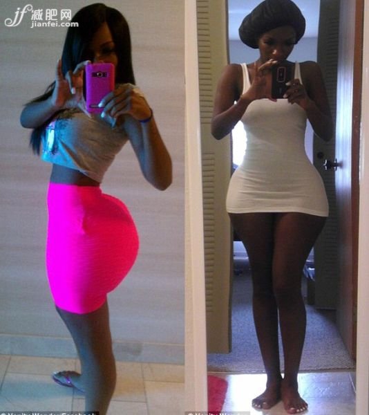 女子豐臀手術后似外星人