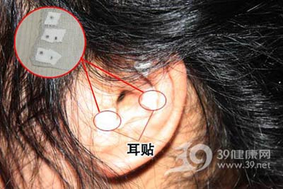 專家提醒:針灸減肥其實(shí)是治“病”過程