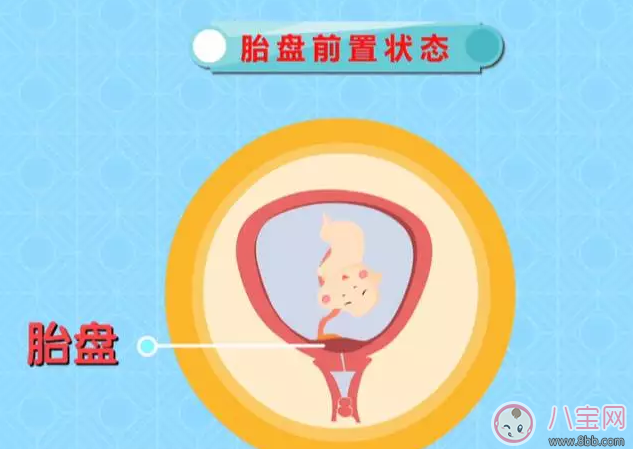 懷孕后那些情況不能順產 有些時候多聽醫(yī)囑準沒錯