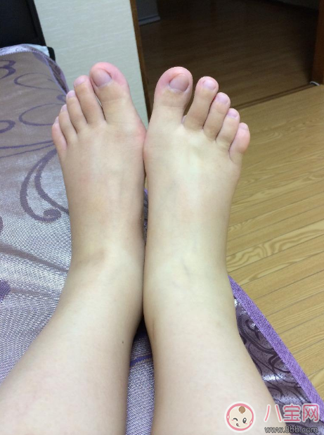 了解好懷孕水腫原因 懷孕水腫很快消 了解好懷孕水腫原因 懷孕水腫很快消