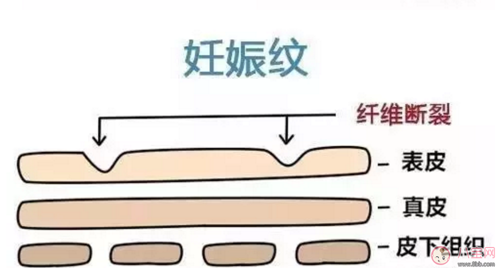 擺脫妊娠紋  哪些方法容易又簡單