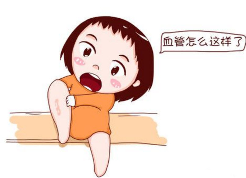 孕婦靜脈曲張是怎么回事 孕婦靜脈曲張怎么緩解