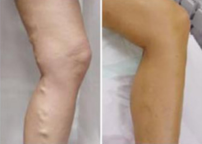 孕婦靜脈曲張是怎么回事 孕婦靜脈曲張怎么緩解