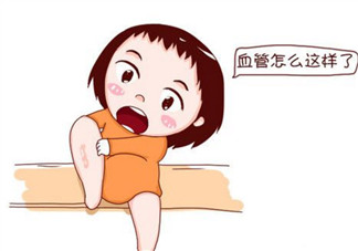 孕婦靜脈曲張是怎么回事 孕婦靜脈曲張?jiān)趺淳徑? data-3bA1=