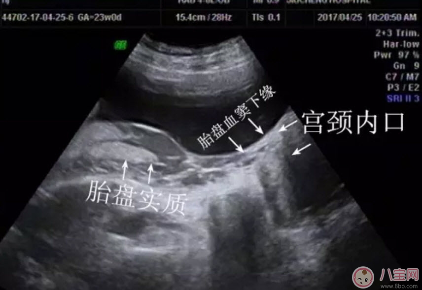 孕婦胎盤低怎么辦 孕婦胎盤低是什么原因造成的(胎盤低要注意什么)