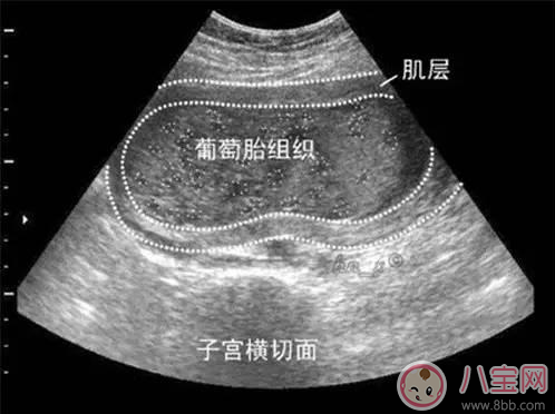 孕吐過后去產(chǎn)檢 卻被告知沒懷孕