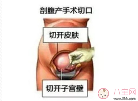 剖腹產(chǎn)孕婦會不會感到疼痛 剖腹產(chǎn)橫剖還是縱剖。