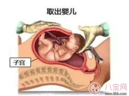 剖腹產(chǎn)孕婦會不會感到疼痛 剖腹產(chǎn)橫剖還是縱剖。