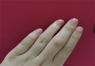 手上長(zhǎng)這個(gè)千萬不要撕 倒刺的正確處理方法