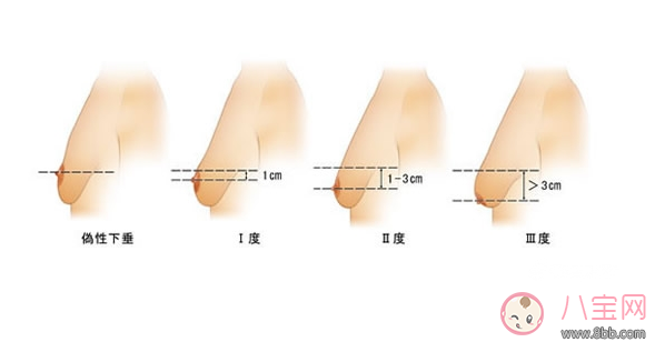 媽媽斷奶后如何豐胸 胸部下垂拯救辦法