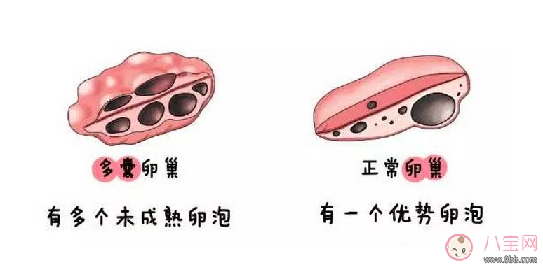 昆凌三胎計劃，昆凌多囊性卵巢癥候群是什么病