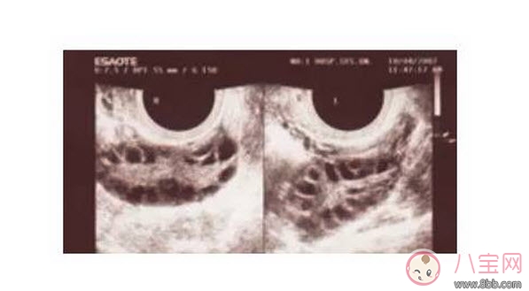 昆凌三胎計劃，昆凌多囊性卵巢癥候群是什么病