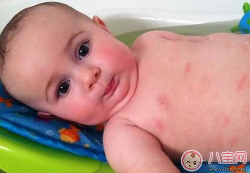 這些情況居然是奶粉過敏 怎么知道孩子吃奶粉過敏了