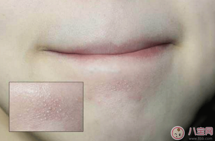 抿嘴時(shí)下巴上面的白色小顆粒是不是粉刺