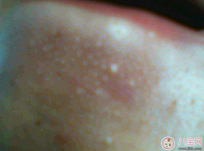 抿嘴時(shí)下巴上面的白色小顆粒是不是粉刺