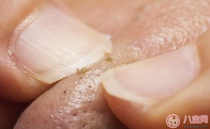 抿嘴時(shí)下巴上面的白色小顆粒是不是粉刺