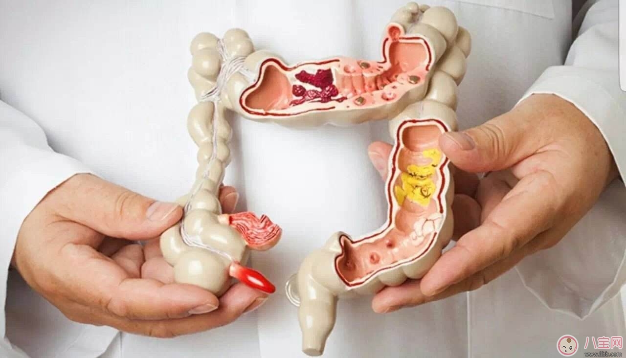 大腸癌常見癥狀 如何預(yù)防大腸癌