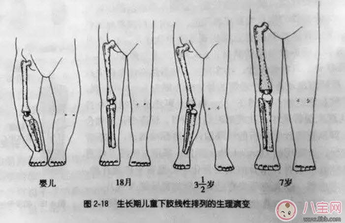 嬰兒為什么是青蛙腿 寶寶青蛙腿用不用綁腿