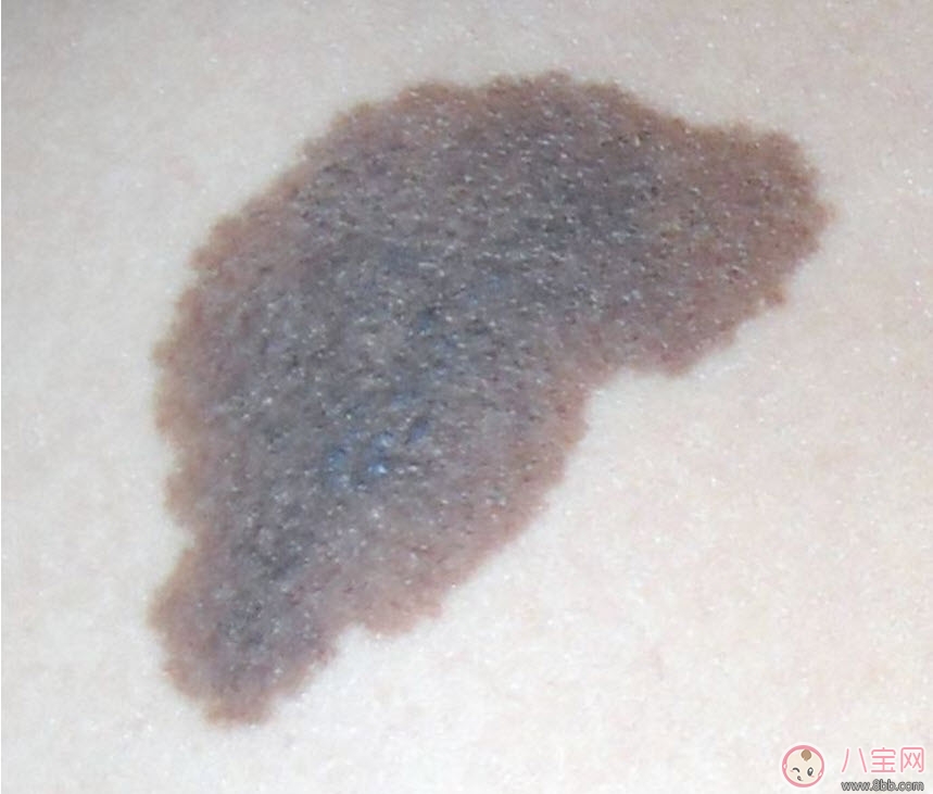 嬰兒屁股下面有胎記有什么含義 新生兒寶寶屁股下面有胎記好不好 嬰兒屁股下面有胎記有什么含義 新生兒寶寶屁股下面有胎記好不好