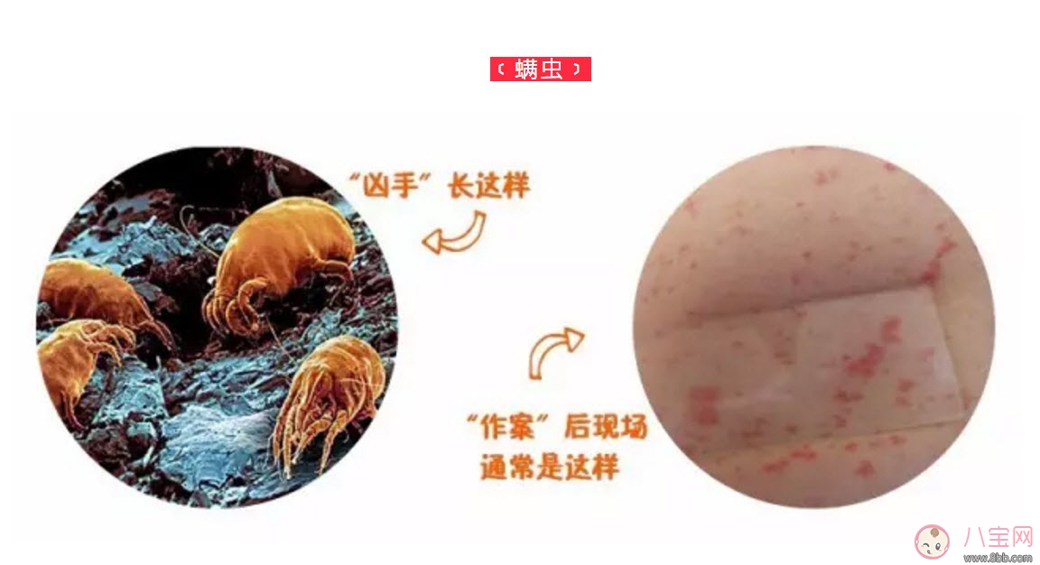 寶寶螨蟲過敏怎么辦，寶寶被螨蟲咬和蚊子咬癥狀對(duì)比圖片區(qū)別