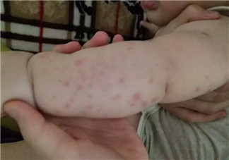 寶寶螨蟲過敏怎么辦，寶寶被螨蟲咬和蚊子咬癥狀對(duì)比圖片區(qū)別