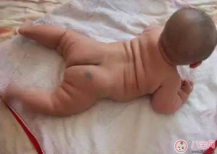寶寶胎記多大治療最好 寶寶治療胎記的最佳時(shí)間