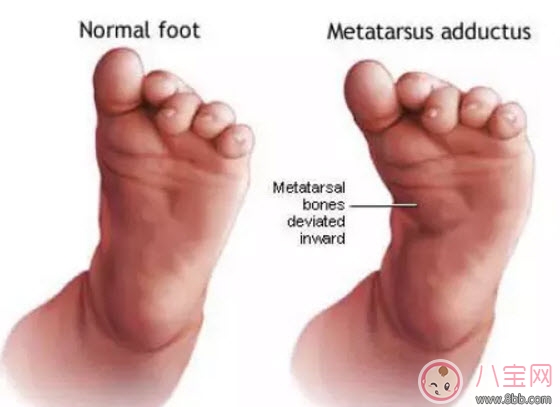 寶寶走路內(nèi)八字怎么辦 寶寶走路內(nèi)八字的原因有哪些