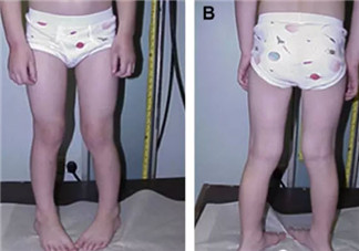 寶寶走路內(nèi)八字怎么辦 寶寶走路內(nèi)八字的原因有哪些