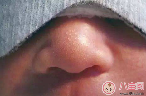 新生兒鼻尖上起了好多小白點是什么 寶寶鼻子上有小白點