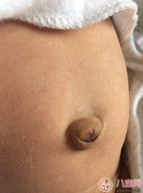 孩子肚子鼓的像個(gè)氣球 寶寶臍疝別忽視