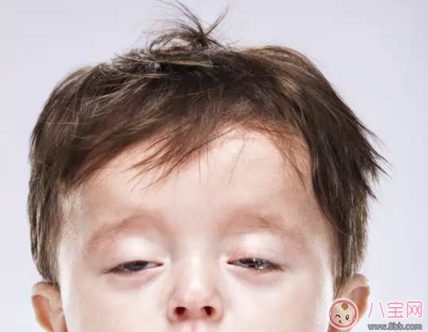 嬰兒鬼臉綜合癥癥狀圖有哪些 過量補(bǔ)鈣造成鬼臉綜合癥的危害是什么 嬰兒鬼臉綜合癥癥狀圖有哪些 過量補(bǔ)鈣造成鬼臉綜合癥的危害是什么