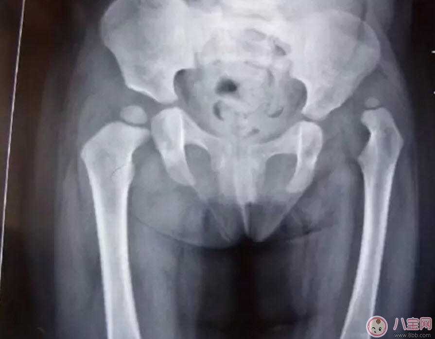寶寶臀紋不對(duì)稱怎么回事 臀紋不對(duì)稱一定是髖關(guān)節(jié)發(fā)育不良嗎