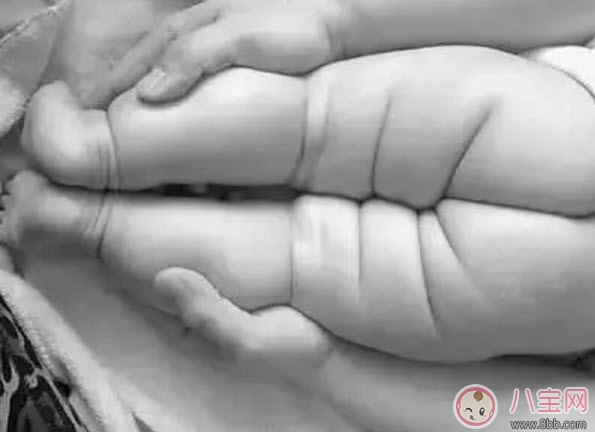 寶寶臀紋不對(duì)稱怎么回事 臀紋不對(duì)稱一定是髖關(guān)節(jié)發(fā)育不良嗎