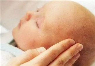 新生兒頭上的乳痂一般什么時(shí)候消失 為什么有的寶寶長(zhǎng)乳痂有的不長(zhǎng)