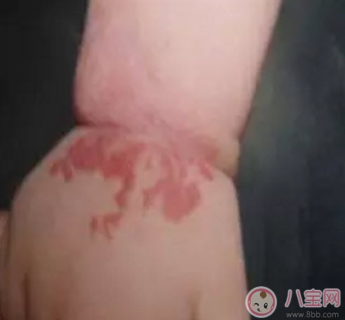 新生兒紅色胎記和血管瘤的對比方法 寶寶胎記和血管瘤的區(qū)別
