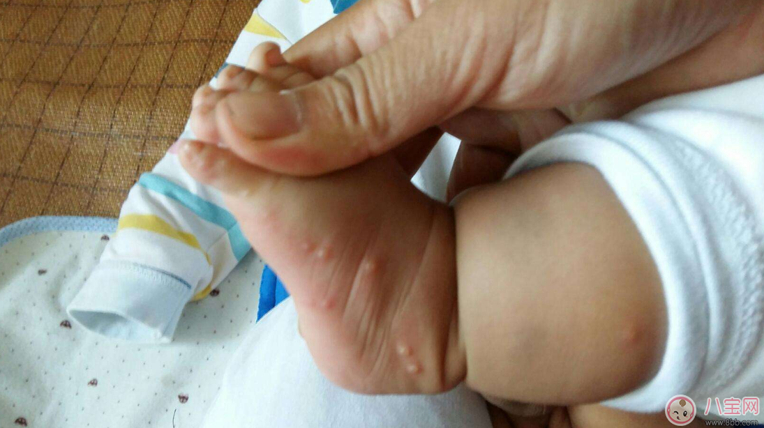 孩子長(zhǎng)水痘這些東西千萬(wàn)遠(yuǎn)離 孩子水痘好得快方法 孩子長(zhǎng)水痘這些東西千萬(wàn)遠(yuǎn)離 孩子水痘好得快方法