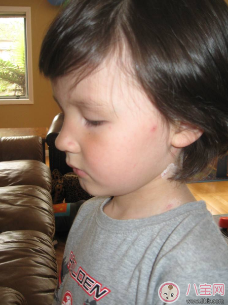 孩子長(zhǎng)水痘這些東西千萬(wàn)遠(yuǎn)離 孩子水痘好得快方法 孩子長(zhǎng)水痘這些東西千萬(wàn)遠(yuǎn)離 孩子水痘好得快方法