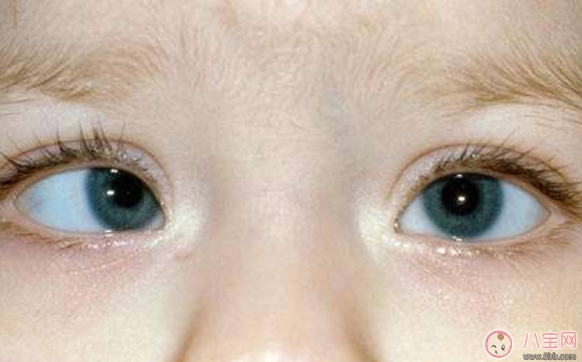 寶寶斜視手術(shù)風(fēng)險大嗎 寶寶斜視一定要做手術(shù)嗎