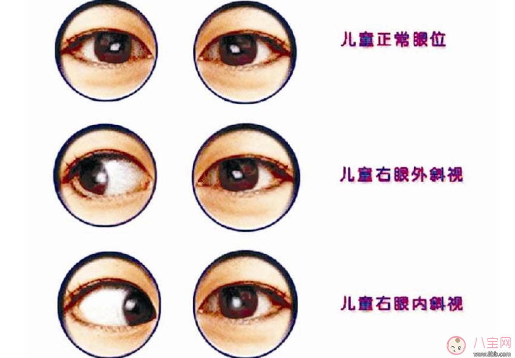 寶寶斜視手術(shù)風(fēng)險大嗎 寶寶斜視一定要做手術(shù)嗎