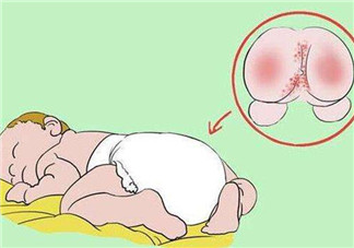 寶寶紅屁股哭鬧怎么辦 寶寶紅屁股安撫物品