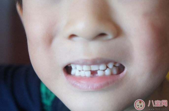 孩子換牙牙不掉 孩子雙排牙要不要拔 孩子換牙牙不掉 孩子雙排牙要不要拔