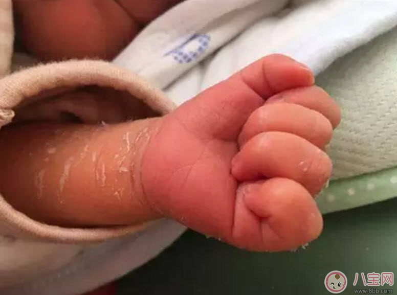 新生兒手腳脫皮要多久 新生兒脫皮怎么護理(能搽點什么)