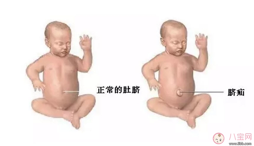 臍疝對寶寶有什么影響 寶寶臍疝是什么原因引起的