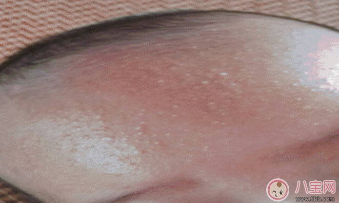寶寶痱子和濕疹的區(qū)別 寶寶濕疹和痱子最大的不同是什么