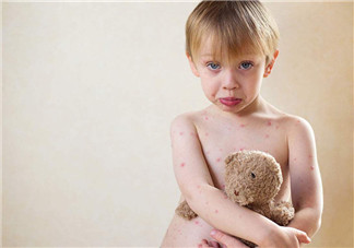 寶寶長(zhǎng)水痘的原因 如何發(fā)現(xiàn)寶寶長(zhǎng)水痘