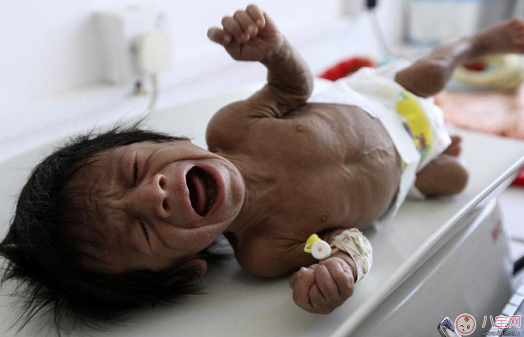 孩子這種情況居然是營養(yǎng)不良的暗示 快給孩子調整過來 孩子這種情況居然是營養(yǎng)不良的暗示 快給孩子調整過來