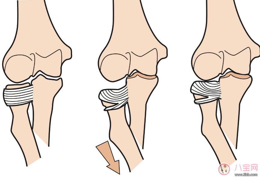 提孩子胳膊“蕩秋千”導(dǎo)致脫臼 孩子胳膊脫臼處理方法 提孩子胳膊“蕩秋千”導(dǎo)致脫臼 孩子胳膊脫臼處理方法