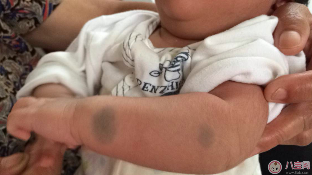 寶寶胎記會自己掉嗎 寶寶胎記去除方法