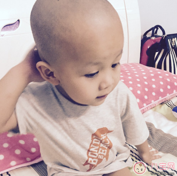孩子夏天剃光頭 小心一不小心變禿頭